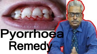 Pyorrhea  Discussion and Treatment in Homeopathy by Dr PS Tiwari [upl. by Chip461]