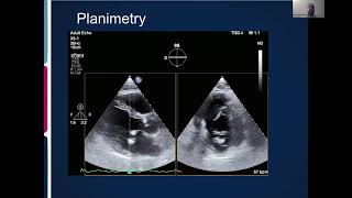 Joint Echo Conference Mitral Stenosis [upl. by Eelyram279]