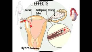 hydrosalpinx [upl. by Francois]