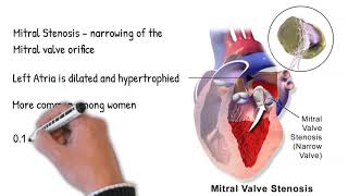 Examples of mitral stenosis murmurs [upl. by Corbin]