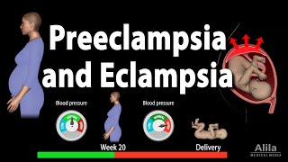 PreEclampsia 10 FACTS YOUR OBGYN WANTS YOU TO KNOW about high blood pressure in pregnancy PART 1 [upl. by Annawyt415]