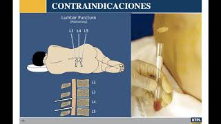 Punción Lumbar Líquido cefalorraquídeo Peritoneo Meninges de la Médula espinal y Cerebro [upl. by Ecart]