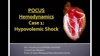 POCUS Hemodynamic Series Part 1 Hypovolemia [upl. by Howard]