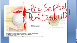 Ophthalmology 417 a Orbital Infection Orbital Cellulitis PreSeptal Post Septal Eye Swelling [upl. by Llertram892]