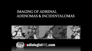 Imaging of Adrenal Adenomas amp Incidentalomas [upl. by Nwad556]