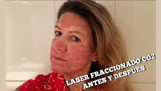 Láser CO2 fraccionado aplicación resultados y beneficios [upl. by Eeruhs]