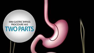 Gastric Sleeve Procedure Sleeve Gastrectomy [upl. by Valentine]