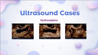 Hydrosalpinx  Ultrasound Cases [upl. by Doe534]