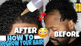 HOW TO GROW Your HAIRLINE BACK FAST [upl. by Ekard895]