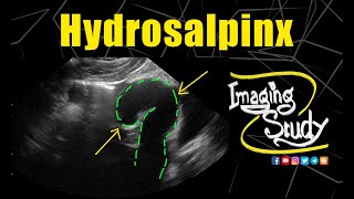 Hydrosalpinx  Ultrasound  Case 202 [upl. by Aniretake]