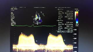 Mitral stenosis PHT [upl. by Tinya]