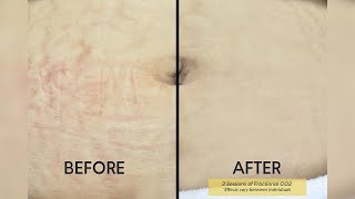 Fractional CO2 Laser Say Goodbye To Stretch Marks  Shinagawa Aesthetics [upl. by Avlem238]