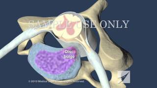 Cervical Disc Herniation [upl. by Sauder773]