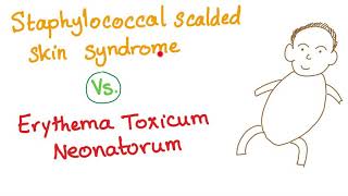 Staphylococcal Scalded Skin Syndrome VS Erythema Toxicum Neonatorum [upl. by Nire]