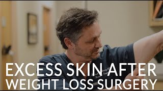 EXCESS SKIN AFTER BARIATRIC SURGERY  How to Handle Loose Skin after Extreme Weight Loss [upl. by Hector]