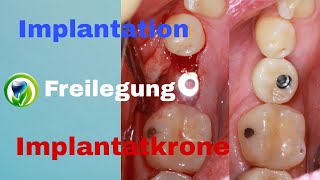 Zahnimplantation Freilegung Abformung Implantatkrone  Ablauf  Zeitraum  Dauer  Termine [upl. by Delgado]