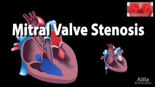 Mitral Valve Stenosis Animation [upl. by Neladgam184]