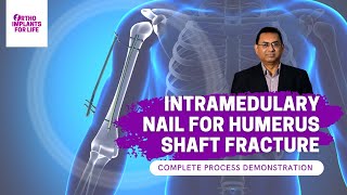 Intramedullary Nail For Humerus Shaft Fracture Procedure [upl. by Alroi413]