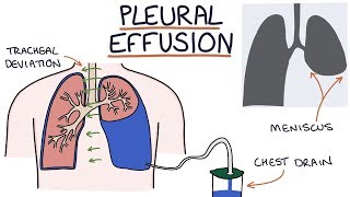 Understanding Pleural Effusions [upl. by Stanislas]