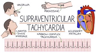 Understanding Supraventricular Tachycardia SVT [upl. by Miguel359]