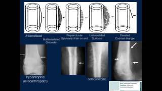 Bone Lesions Radiographic Assessment Part 1 by Geoffrey Riley MD [upl. by Furie]