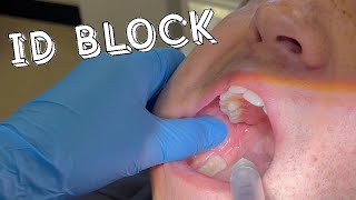 HOW TO SUCCEED AT AN INFERIOR DENTAL NERVE BLOCK INJECTION  DENTISTRY  Profound amp Painless [upl. by Kare]