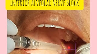 Inferior Alveolar Nerve Block is EASY [upl. by Weslee532]