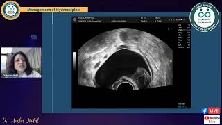 Managing Hydrosalpinx before IVF [upl. by Ajnat]