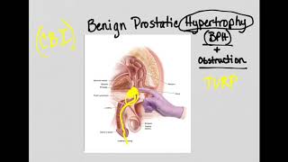 Urinary Obstruction and BPH [upl. by Anirac210]