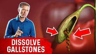 Do This to Help Dissolve Gallstones [upl. by Aenal]