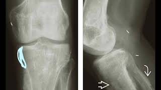 18 HYPERTROPHIC OSTEOARTHROPATHY [upl. by Madi]