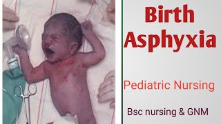 Birth asphyxia or Asphyxia neonatorum [upl. by Dorcy]