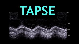 All about TAPSE Echocardiography [upl. by Ratcliffe43]