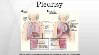 Pleurisy [upl. by Fradin]