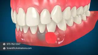 Gum Grafting Surgery  Dental Animation [upl. by Claudine]