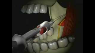 Mandibular Anesthesia  Inferior Alveolar Nerve Block [upl. by Eedia]