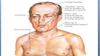 Myotonic dystrophy [upl. by Rexanna]