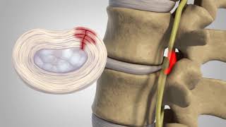 Herniated Disc  Patient Education [upl. by Mcripley]