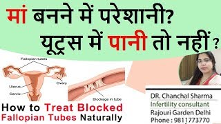 Hydrosalpinx Treatment Naturally in Hindi Fallopian Tube Blockage  Dr Chanchal Sharma [upl. by Audette]