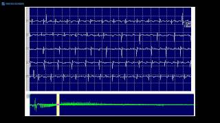 Myotonic dystrophy Causes Signs and Symptoms Diagnosis and Treatment [upl. by Aehcsrop]