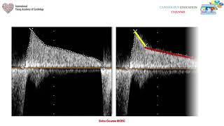 Episode 11 Mitral Stenosis [upl. by Oivatco]