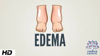 Edema Causes Signs and Symptoms Diagnosis and Treatment [upl. by Yankee]