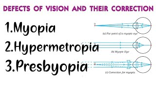 Myopia Hypermetropia Presbyopia DEFECTS IN HUMAN EYE AND THEIR CORRECTION Class 10 physics [upl. by Ajam]