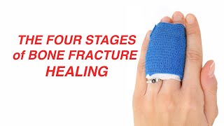 The Four Stages of Bone Fracture Healing [upl. by Acenes383]