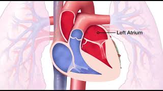 Mitral Valve Regurgitation [upl. by Felisha]