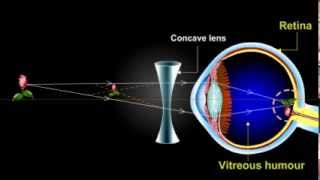 what is myopia Short Sightedness [upl. by Sivrep]