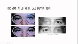 Strabismus surgery Recession [upl. by Kerstin]