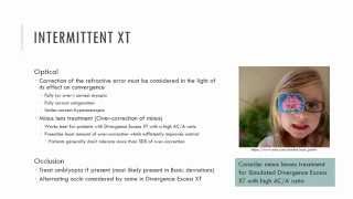 Intermittent Exotropia Management [upl. by Anairo]