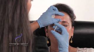 Botulinum Toxin  Injection Technique [upl. by Tager]