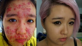 From Severe Acne to Clear Skin [upl. by Dnalevelc]